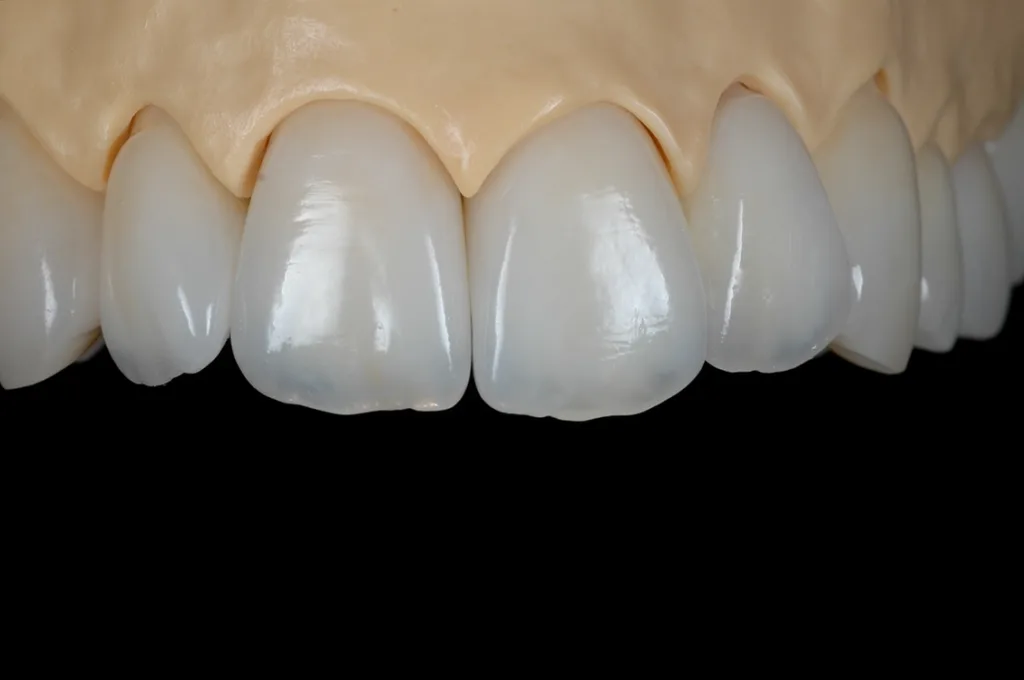 Für anspruchsvolle ästhetische Kronen sowie für komplexe Unterstrukturen, z.B. von zahn- oder implantatgetragenen Brücken: Verblendkeramik auf Feldspatbasis (Initial Zr-FS, GC).
