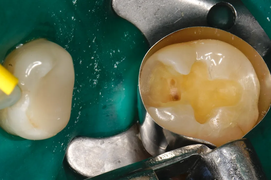 Angelegte zirkuläre, anatomisch geformte Tofflemire-Matrize.