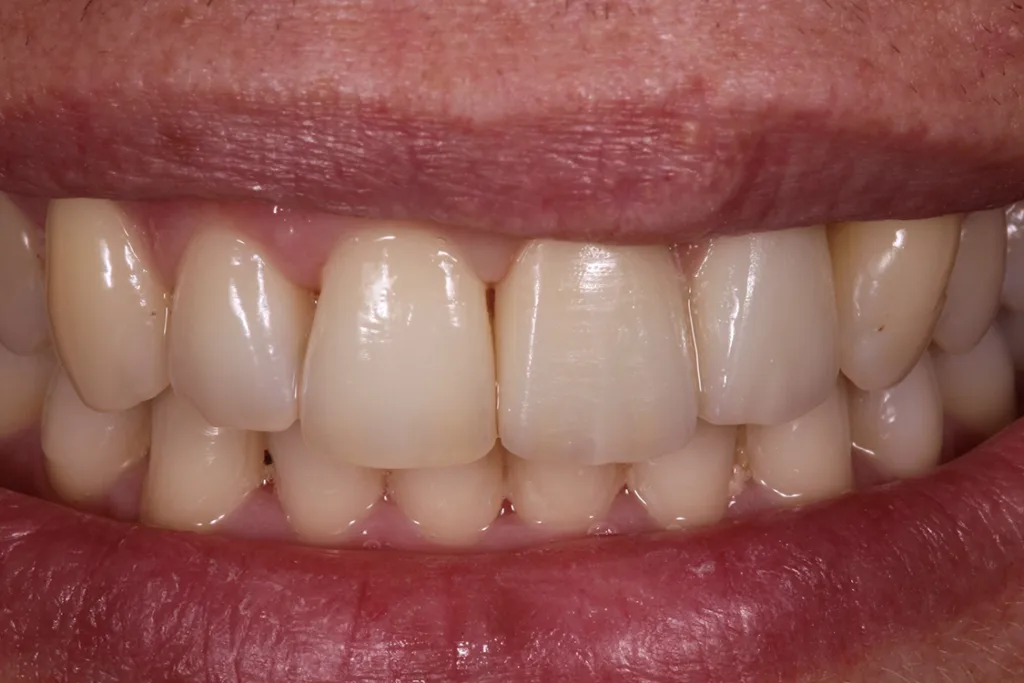 Für anspruchsvolle ästhetische Kronen sowie für komplexe Unterstrukturen, z.B. von zahn- oder implantatgetragenen Brücken: Verblendkeramik auf Feldspatbasis (Initial Zr-FS, GC).