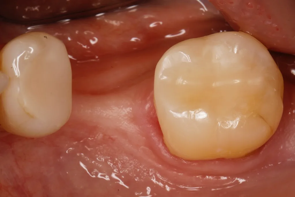 Die fertig versorgte Kavität bei einer Nachkontrolle nach vier Wochen.