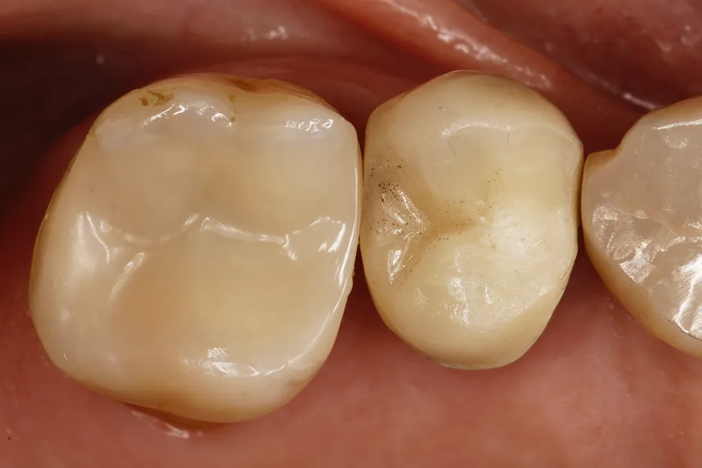 Ausgearbeitete und polierte Versorgung des Zahnes unter Einfassung des distopalatinalen Höckers.