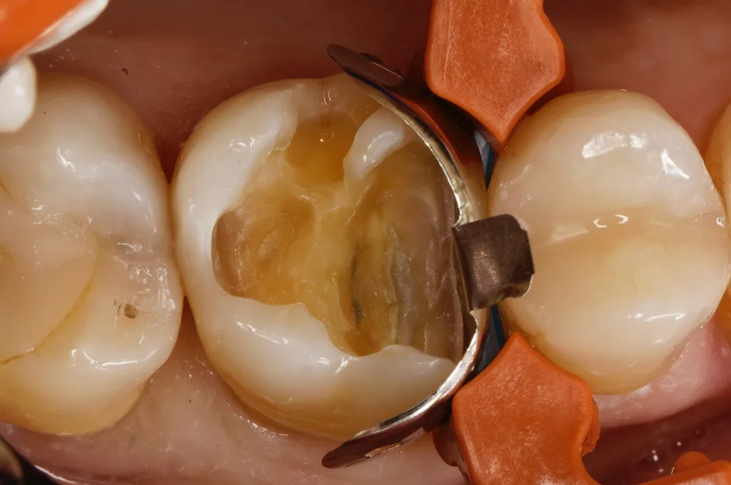 Mit einer Teilmatrize eingeschalte, größere om-Kavität an Zahn 16.