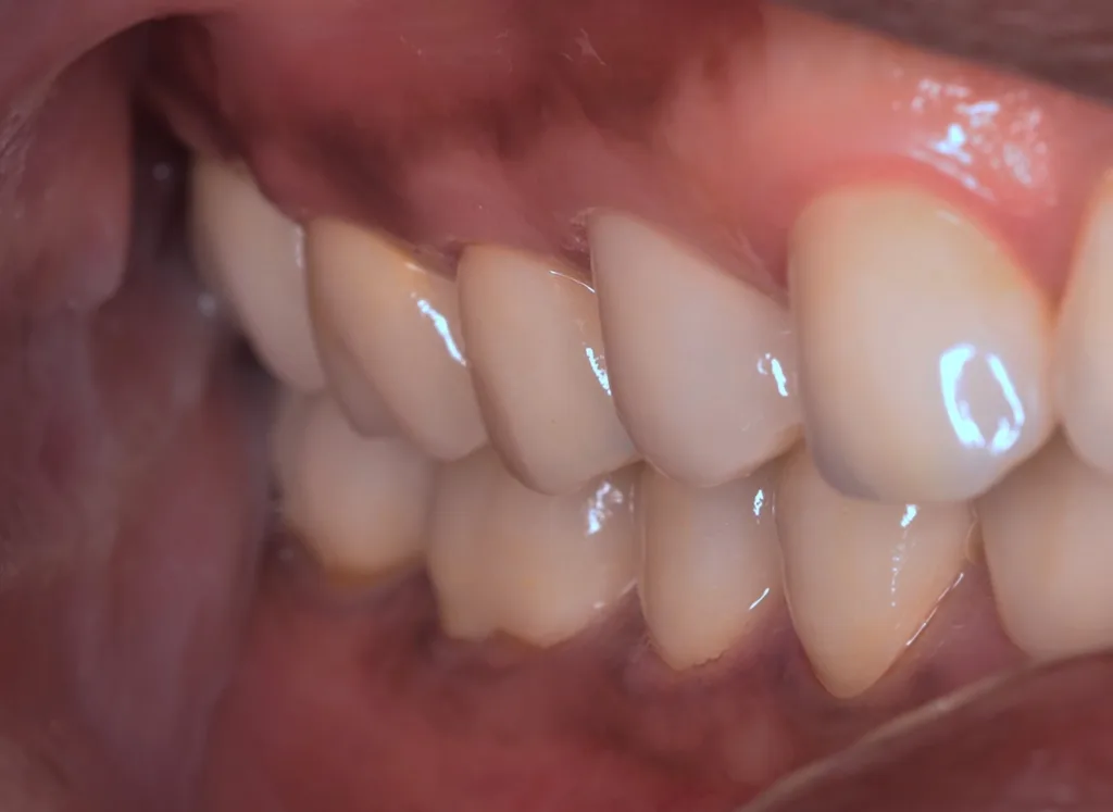 Abb. 13: Bukkale Perspektive mit perfekter Gingiva