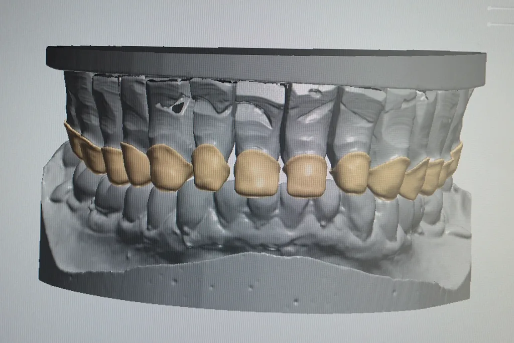 Abb. 4: Konstruktion des Oberkiefers