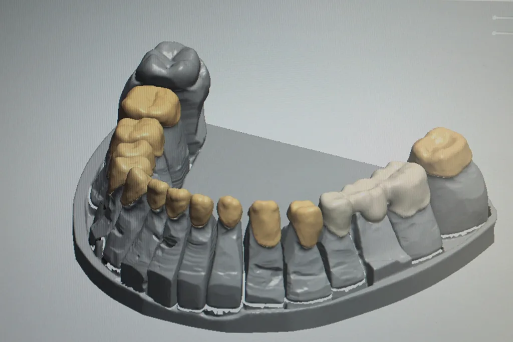 Abb. 5: Konstruktion des Unterkiefers