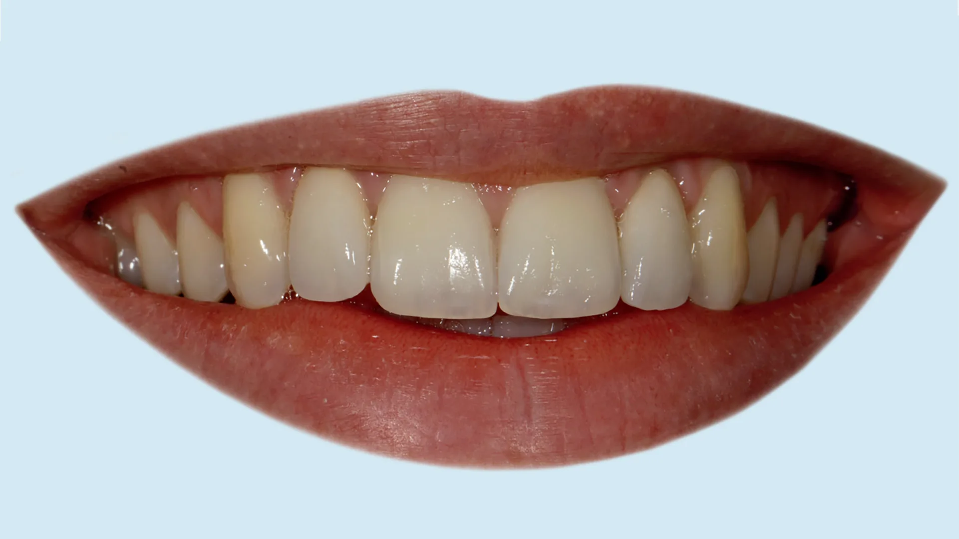 Ein lachender Mund mit schönen und geraden Zähnen.