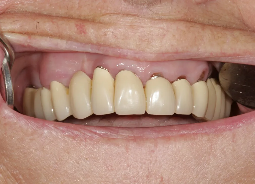 Der Gegenbiss in situ