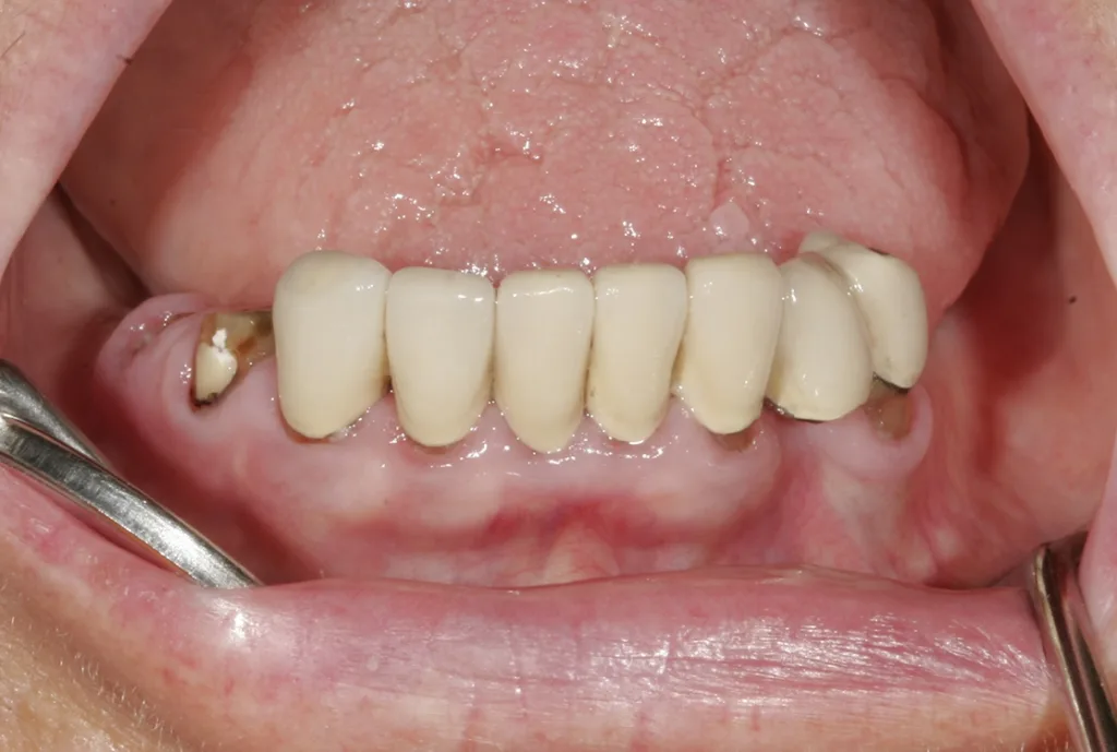 Eine alte VMK-Versorgung