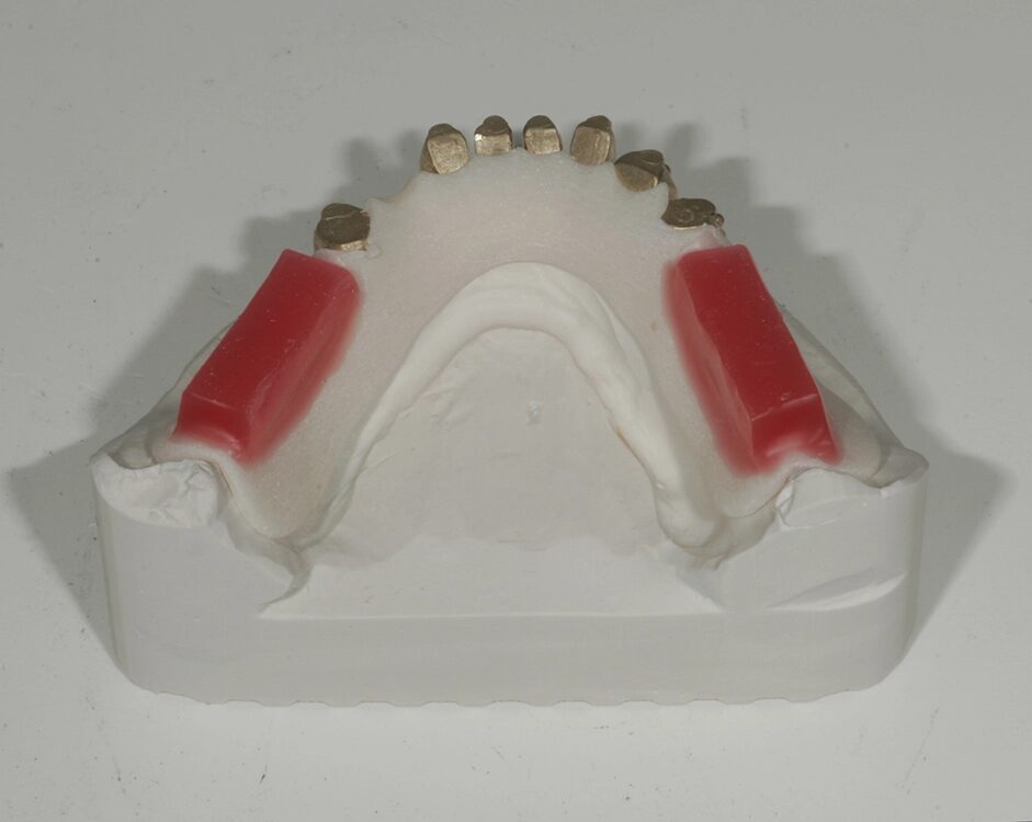 Bissschablone mit Wachswällen
