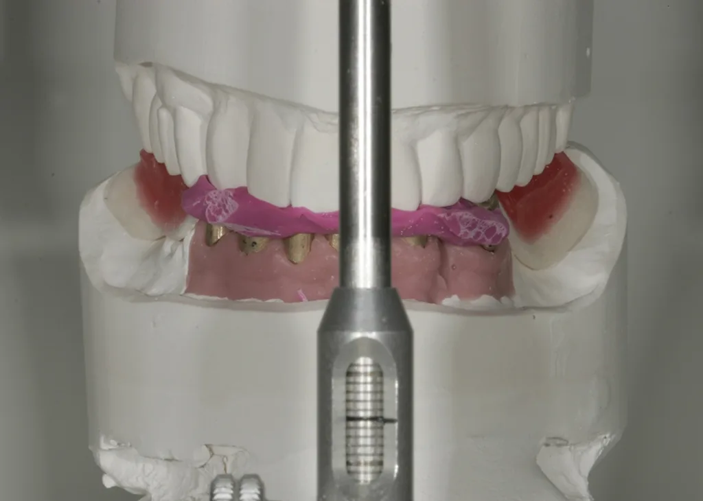 Gegenbiss eingestellt