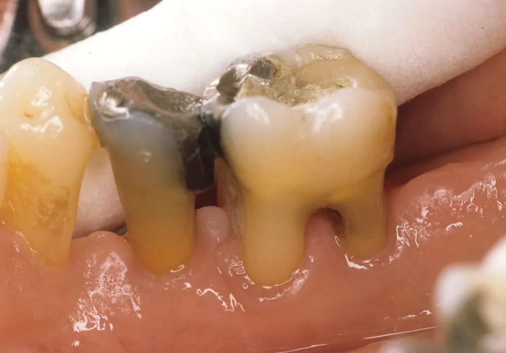 Weit fortgeschrittene Parodontitis mit chronischer Restentzündung und Bakteriämie. Mangelnde Hygienefähigkeit, Kaukomfort und Ästhetik mit Karies in der Furkation.