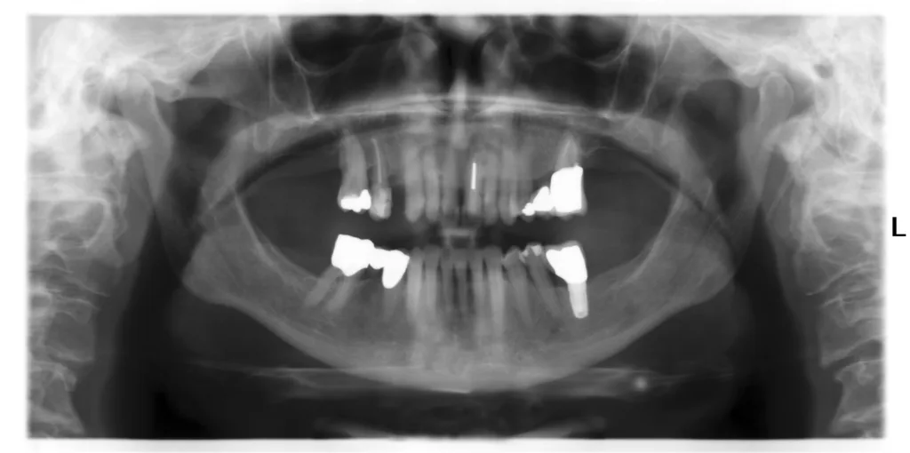 Zu lange Wartezeit bei schwerer chronischer Parodontalerkrankung regio 15, 16 mit vertikaler Schädigung des Implantatlagers (siehe auch Abb. 14)