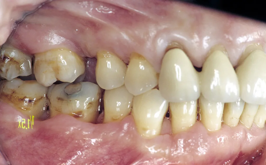 Nach parodontaler Zieltherapie werden tiefe Resttaschen zur Sicherung des Restzahnbestandes zum weiteren Entzündungsschutz vor Implantation chirurgisch korrigiert.