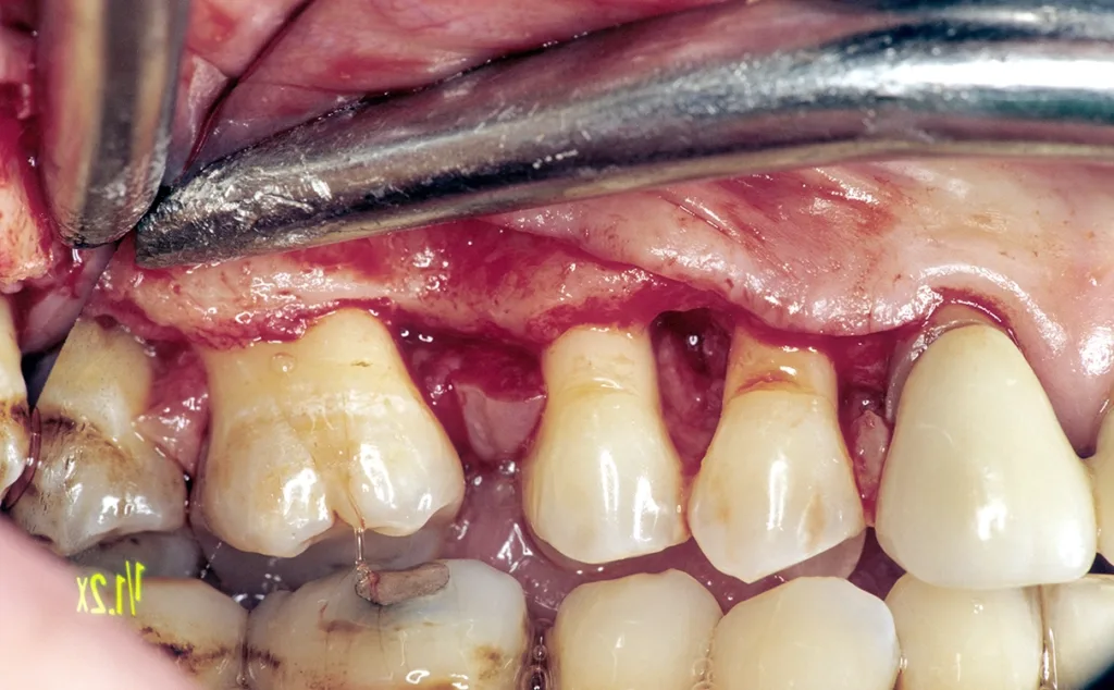 Mikrochirurgische Revision mit vaskulär gestieltem Palatinallappen zur Papillenerhaltung und Auffüllen der Knochentaschen mit autogenem Knochen, antiinflammatorisch unterstützt durch Osteora, alternativ EMD.