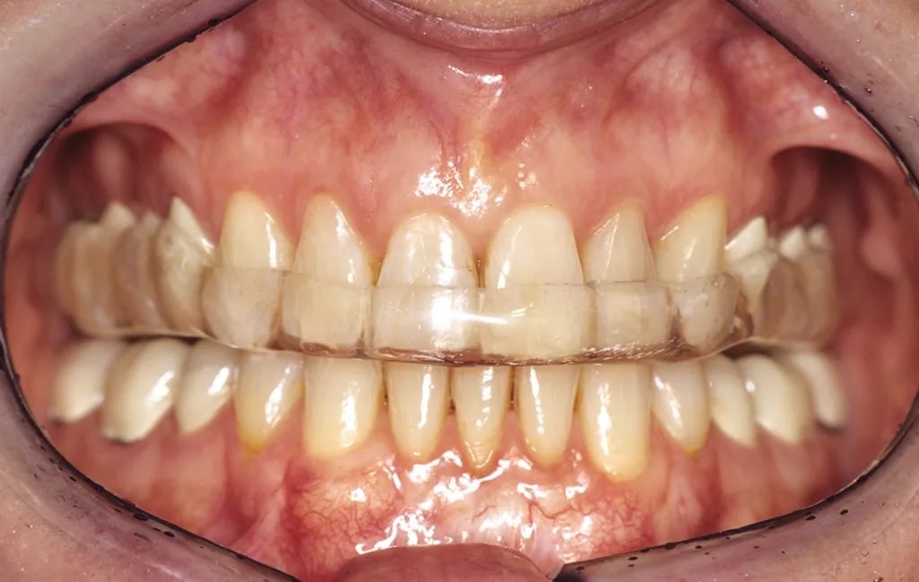 OK-Relaxierungsschiene mit frontalem Aufbiss zur funktionellen Dekompensation bei alters- und gebrauchsbezogener Bisssenkung vor definitiver Implantatplanung.