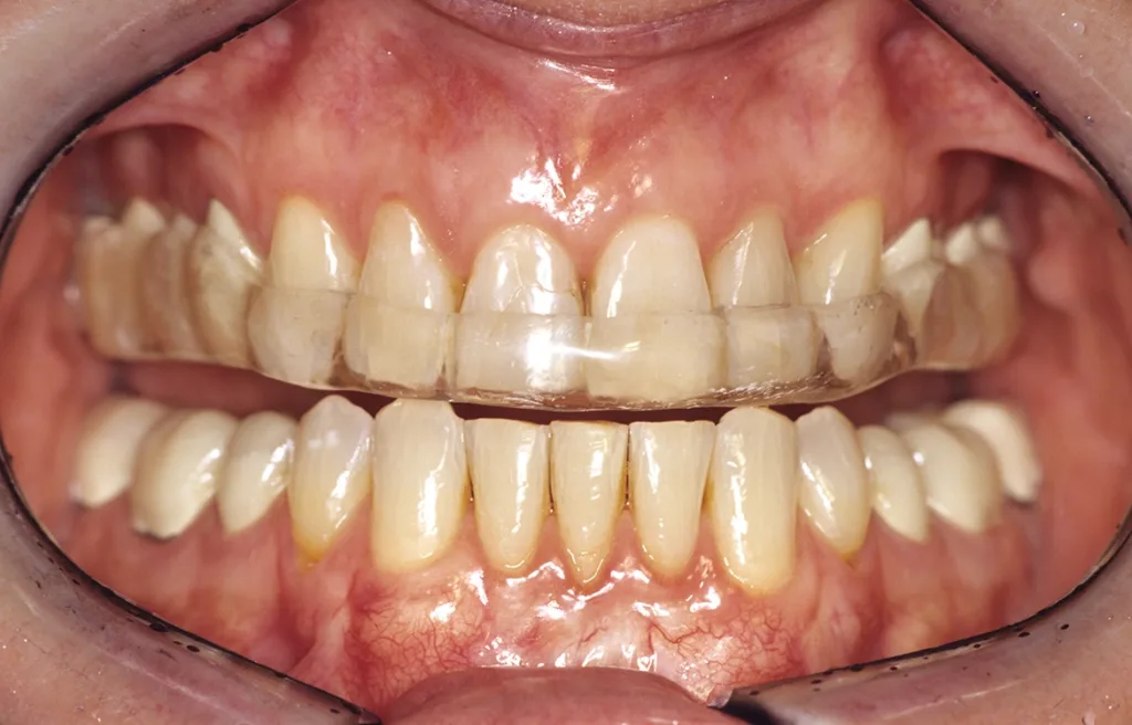 Temporäre Entlastung von schadhaften Gebrauchs- und Gewohnheitsmustern durch Wiederherstellung der Front-Eckzahn-Führung.