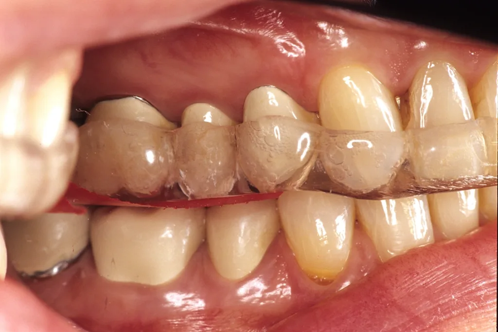 Zur Vorbereitung der Implantation und Beschleunigung der Knochenheilung bei chronischen parodontalen Schäden minimale vertikale Freistellung von 1 mm mit Entlastung des Molarenbereichs.