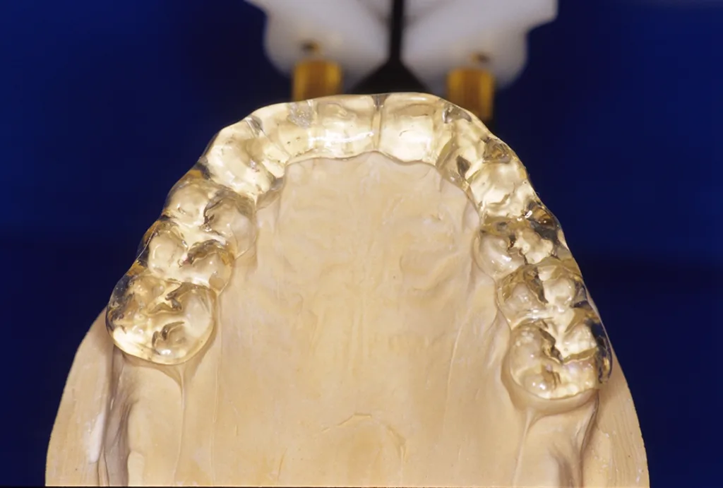 ch bei vollständiger Zahnreihe erfolgt die Ausdehnung der Streuschiene (1,5 mm Dicke) bis zum Sechsjahrmolaren.