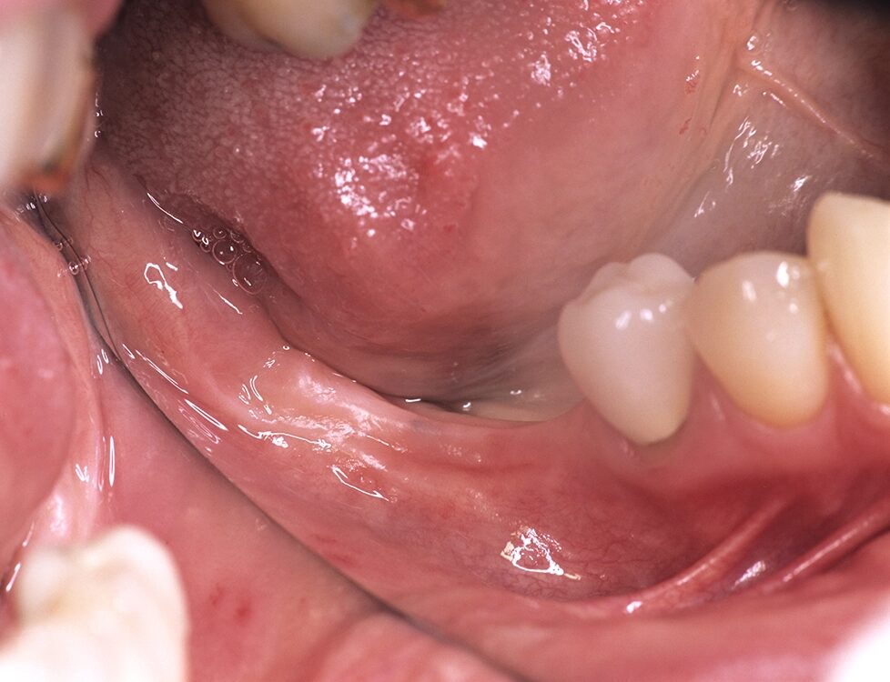 Fortgeschrittene vertikale UK-Alveolarkammatrophie mit Knochenkammgrat, vestibulär abfallendem Knochenniveau, Nervnähe und schmaler keratinisierter Gingiva.