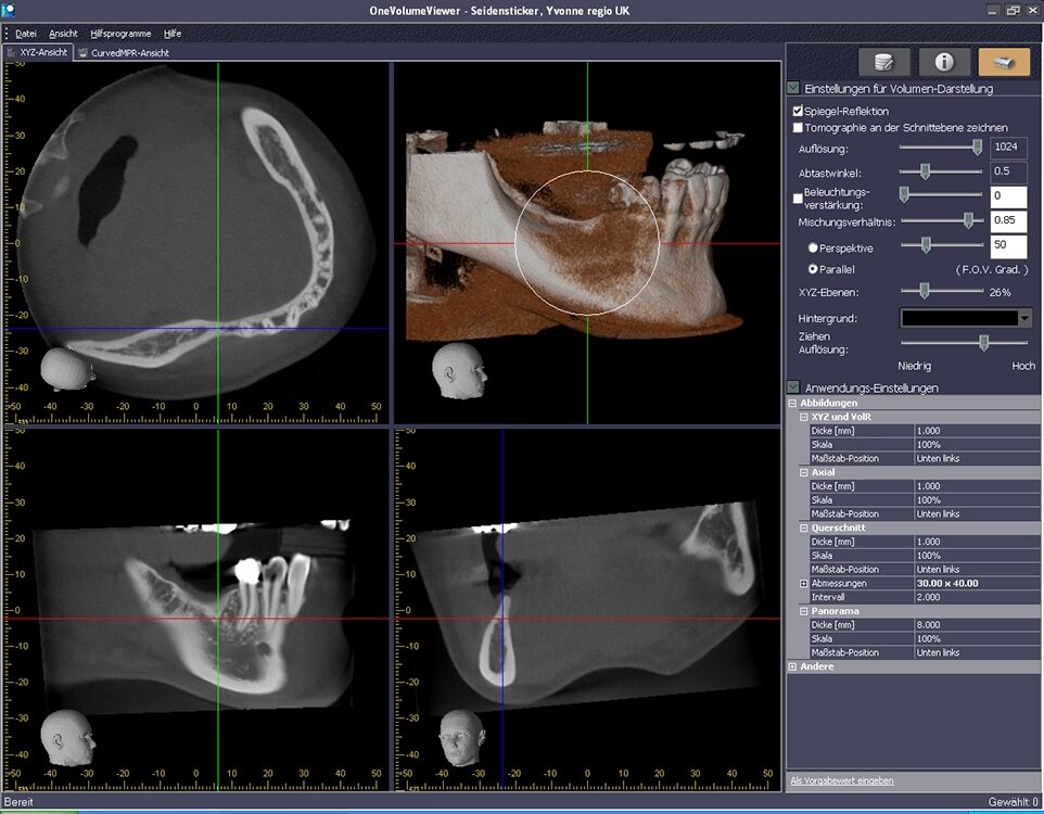 Sicherung der Implantatplanung (Implantatlängen, Positionierung, Durchmesser und operatives Vorgehen) durch DVT-Beurteilung (Cranium Bonn 2014).