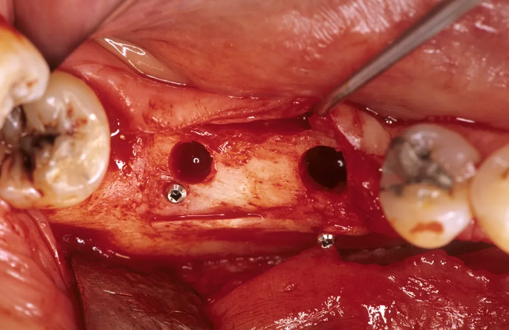 Interimplantäre Mindestabstände von 7 mm im Front- und Prämolarengebiet mit 11 mm im Molarenbereich aus prothetischer Sicht und Schutz vor periimplantären Knochenschäden (Vaskularisation); Chirurgie: Dr. G. Kochhan.