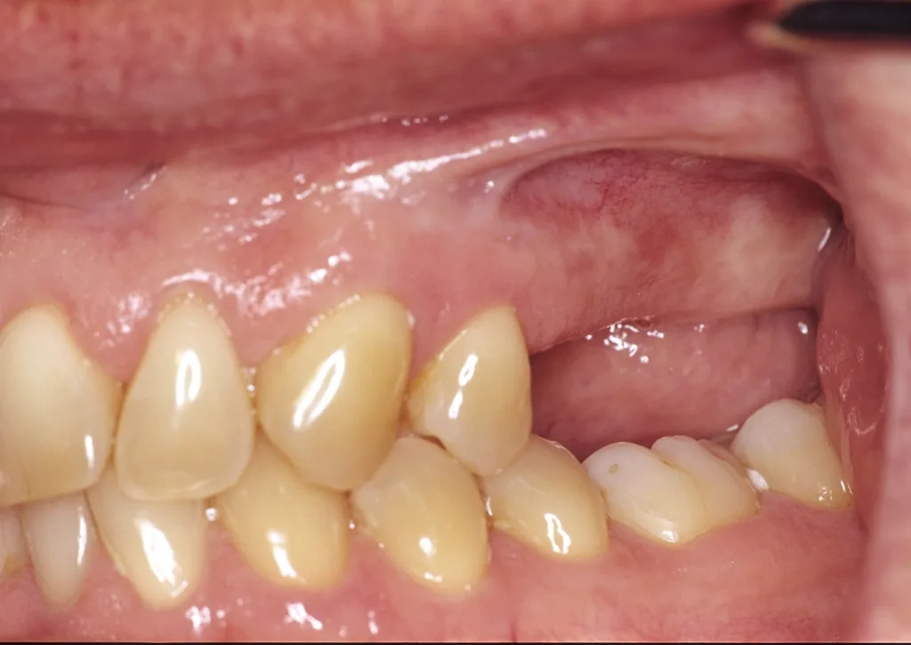 Unzureichendes Knochenangebot mit vestibulär fehlendem Implantatknochen nach Zahnverlust durch traumatische Kreuzbissbeziehung im linken Oberkiefer.