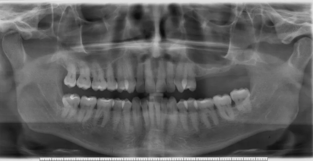 OPG-Ausgangsbefund mit kombiniert vertikal lateralem Knochendefizit. Augmentation mit Sinuslift (vertikal) und BoneShield-Technik (lateral) und nachfolgender Implantation 25, 26, 27.