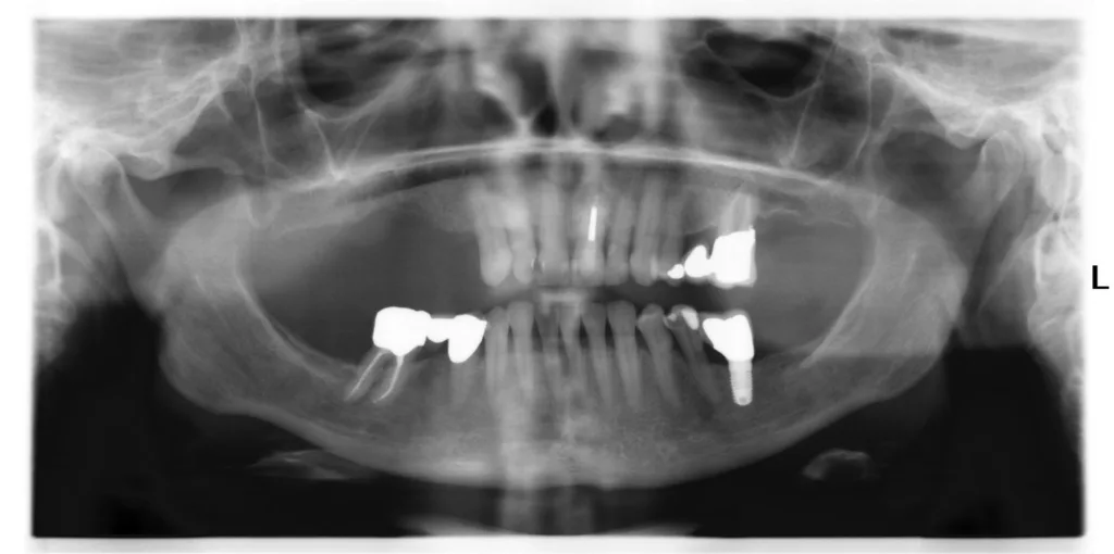 Durch langjährigen parodontalen Schaden (siehe Abb. 2) verursachter vertikaler Implantatknochenverlust regio 16. Vermeidung des Sinuslifts durch 3D-Analyse mit sinusnaher Implantation.