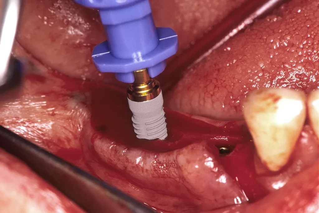 Minimale Implantation mit Schonung des Implantatknochens unter Verzicht auf maschinelles Einbringen, Implantatinsertion mittels Drehmomentschlüssel.