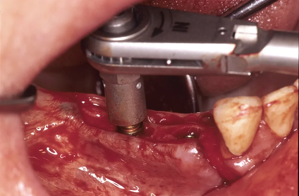 Förderung der Knochen- und Gewebedurchblutung (Perfusion) und Implantateinheilung durch minimale Implantatchirurgie mit Insertion des Implantatpfostens in vaskularisiertes, durchblutetes Knochenlager.