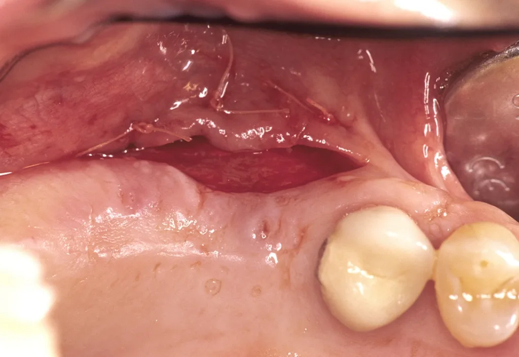 Vestibuläre Gingivaextension mit apikaler Fixierung vor Schleimhauttransplantation während der Implantateinheilung.