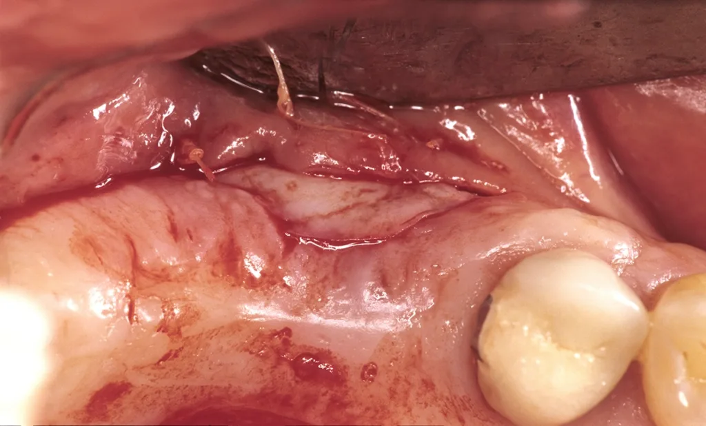 Freies Schleimhauttransplantat in situ vor Nahtfixierung.