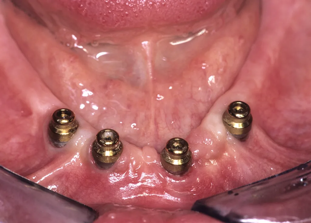 Instabiles periimplantäres Weichgewebe mit mangelnder Hygienefähigkeit, persistierender Entzündung regio 34 und chronischer Empfindlichkeit.