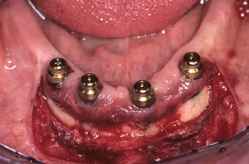 Gestielte Lappenplastik nach Edlan-Mejchar zur Verbreiterung der periimplantären Gingiva mit attached Mukosa bei vestibulär fehlendem Implantatknochen und überdimensioniertem Implantatdurchmesser.
