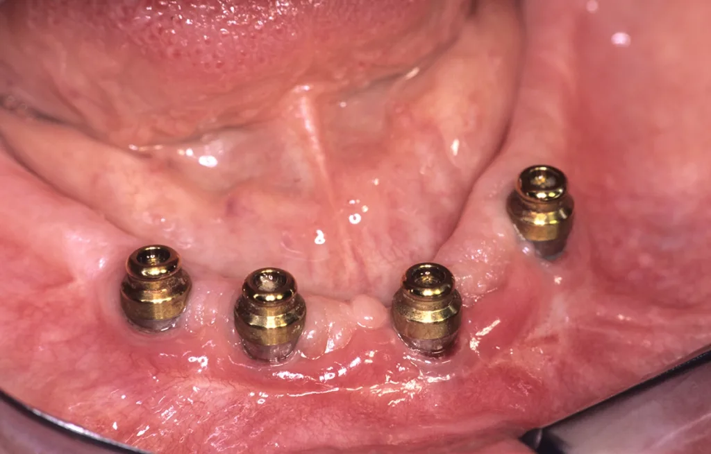 Reizfreie, ästhetisch akzeptable Einheilung acht Wochen postoperativ mit funktioneller Entlastung durch Verbreiterung und periimplantärer Stabilisierung.