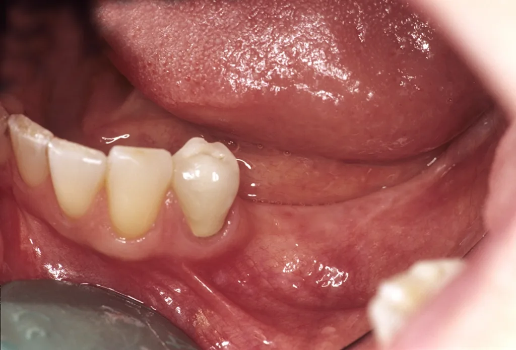 Indikation zur Insertion kurzer durchmesserreduzierter Implantate bei Freiendsituation im Unterkiefer und geringer Restknochenhöhe.