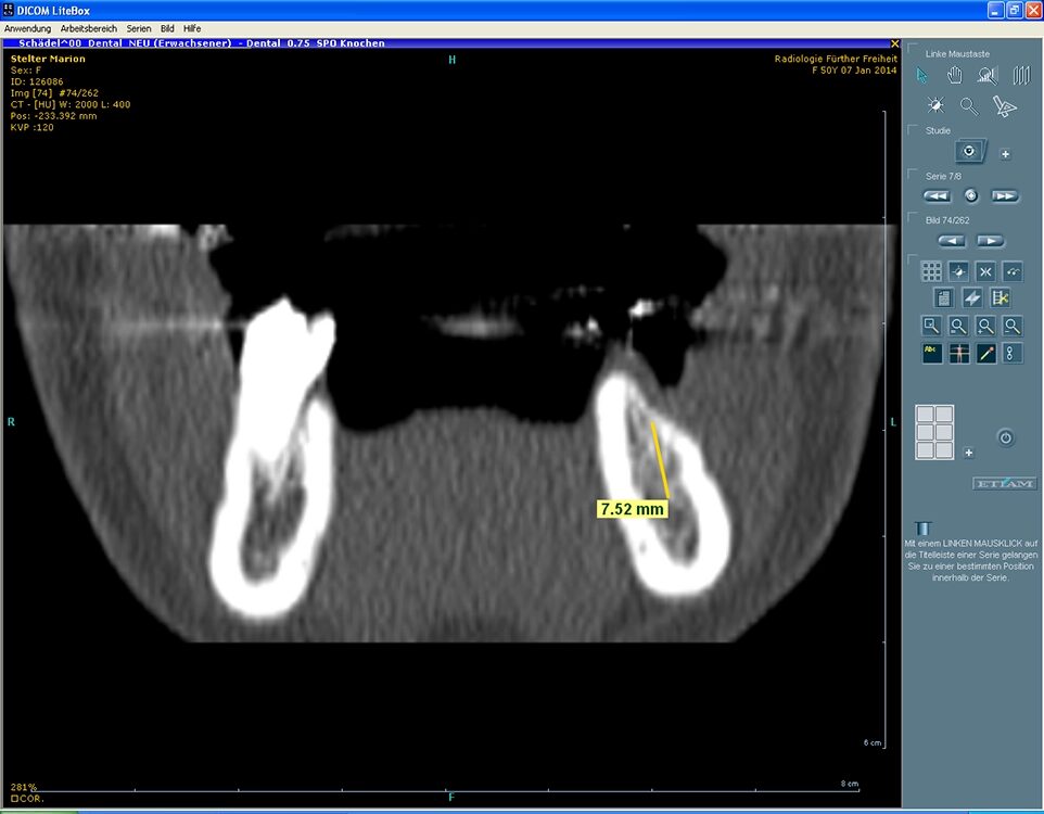 Sicherung der Implantatplanung und Durchführung durch 3D-Visualisierung mit reduzierter Implantatlänge von 7 mm bei Kammresorption mit Nervnähe (Radiologie Fürther Freiheit, 2014).