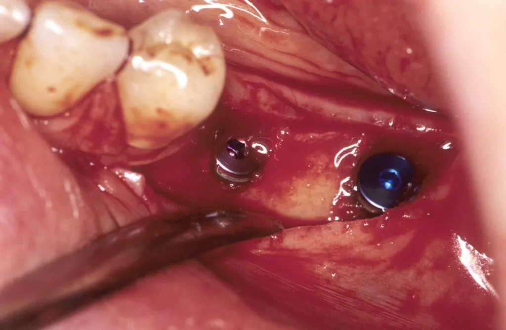 Intraoperativer Situs nach Implantation kurzer Implantate (7 mm) mit prothetisch relevantem Durchmesser (Schulter) von 4,3 und 5,0 mm.
