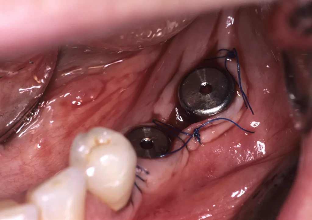 Die resorptionsbedingt schmale periimplantäre Gingiva wird während der Freilegung durch einen 1 mm oralwärts gelegenen horizontalen Kieferkammschnitt vertikal verbreitert.