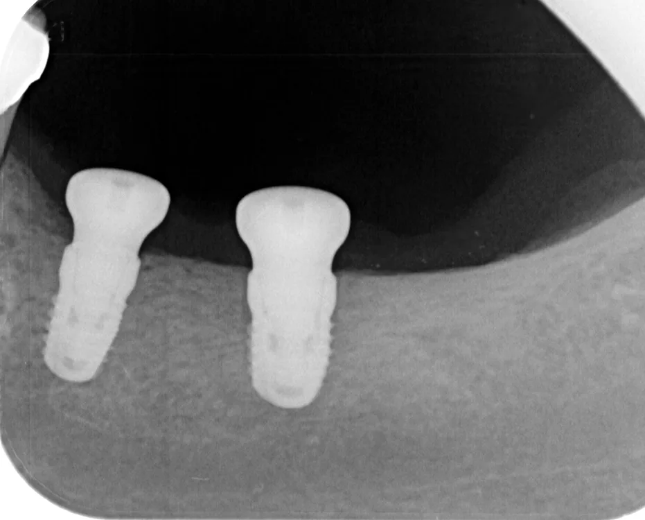 Präoperatives OPG mit Anzeichen von Demineralisation und Hinweis auf laterale Kammatrophie regio 35, 36.