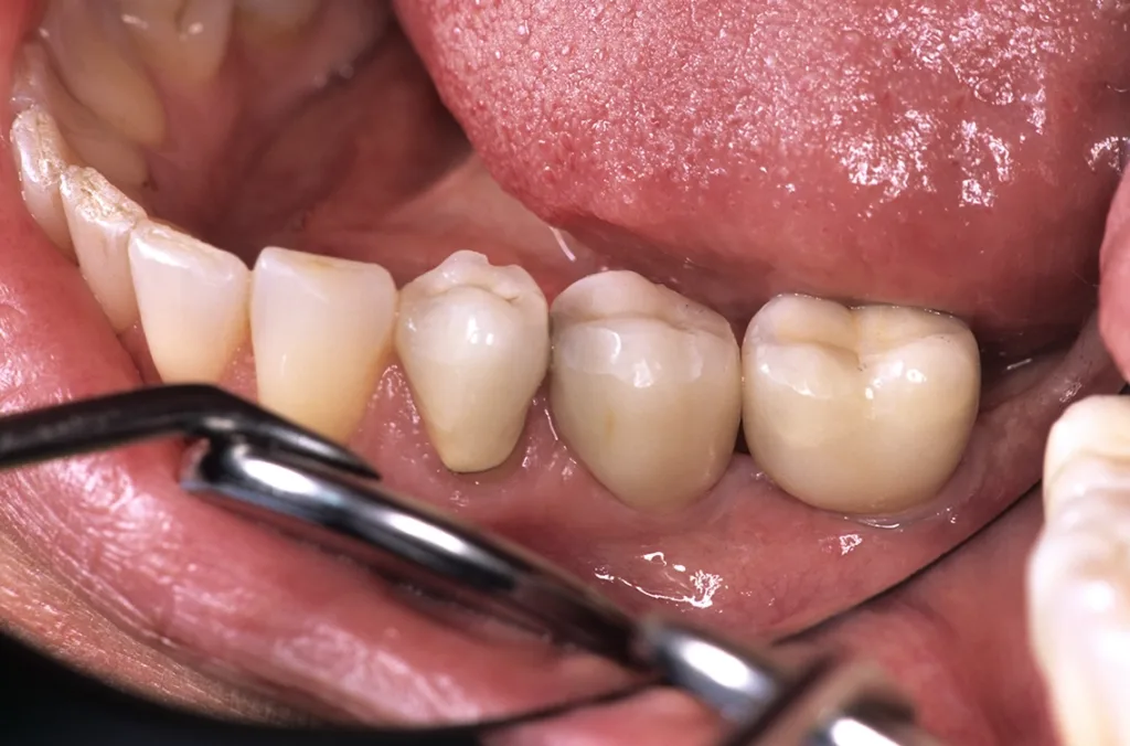 Sicherung der Implantatplanung und Durchführung durch 3D-Visualisierung mit reduzierter Implantatlänge von 7 mm bei Kammresorption mit Nervnähe (Radiologie Fürther Freiheit, 2014).