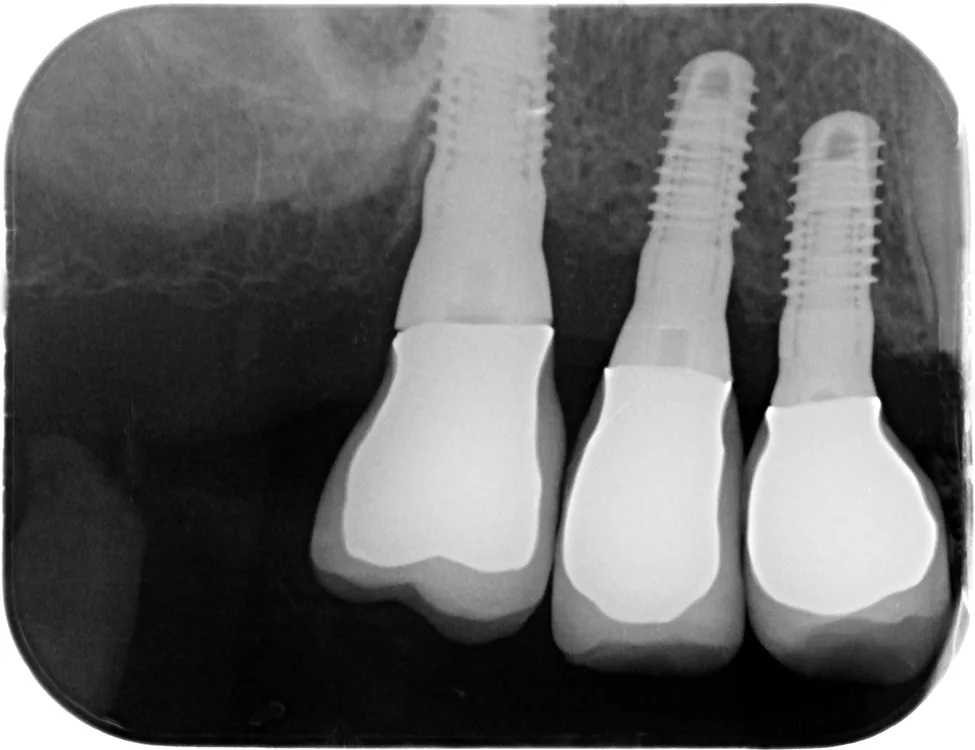 Intraoperativer Situs nach Implantation kurzer Implantate (7 mm) mit prothetisch relevantem Durchmesser (Schulter) von 4,3 und 5,0 mm.