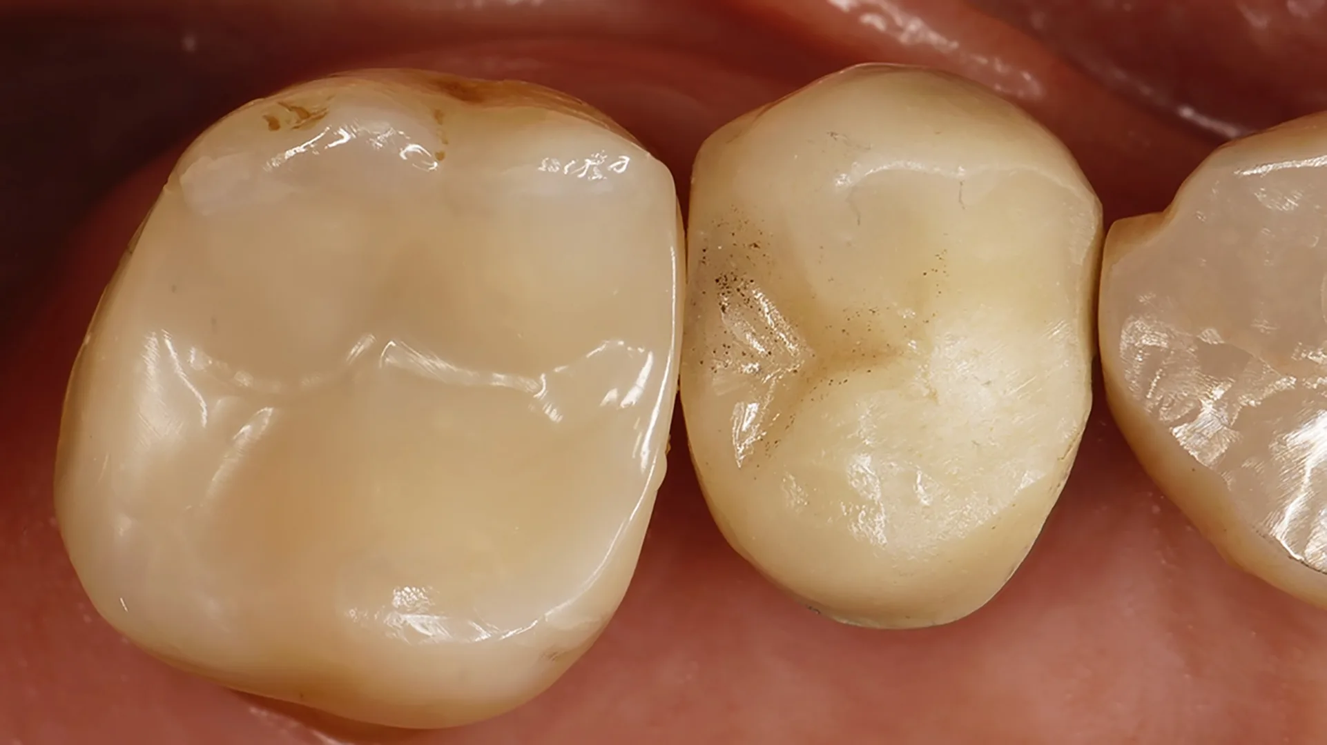 Ausgearbeitete und polierte Versorgung des Zahnes unter Einfassung des distopalatinalen Höckers.