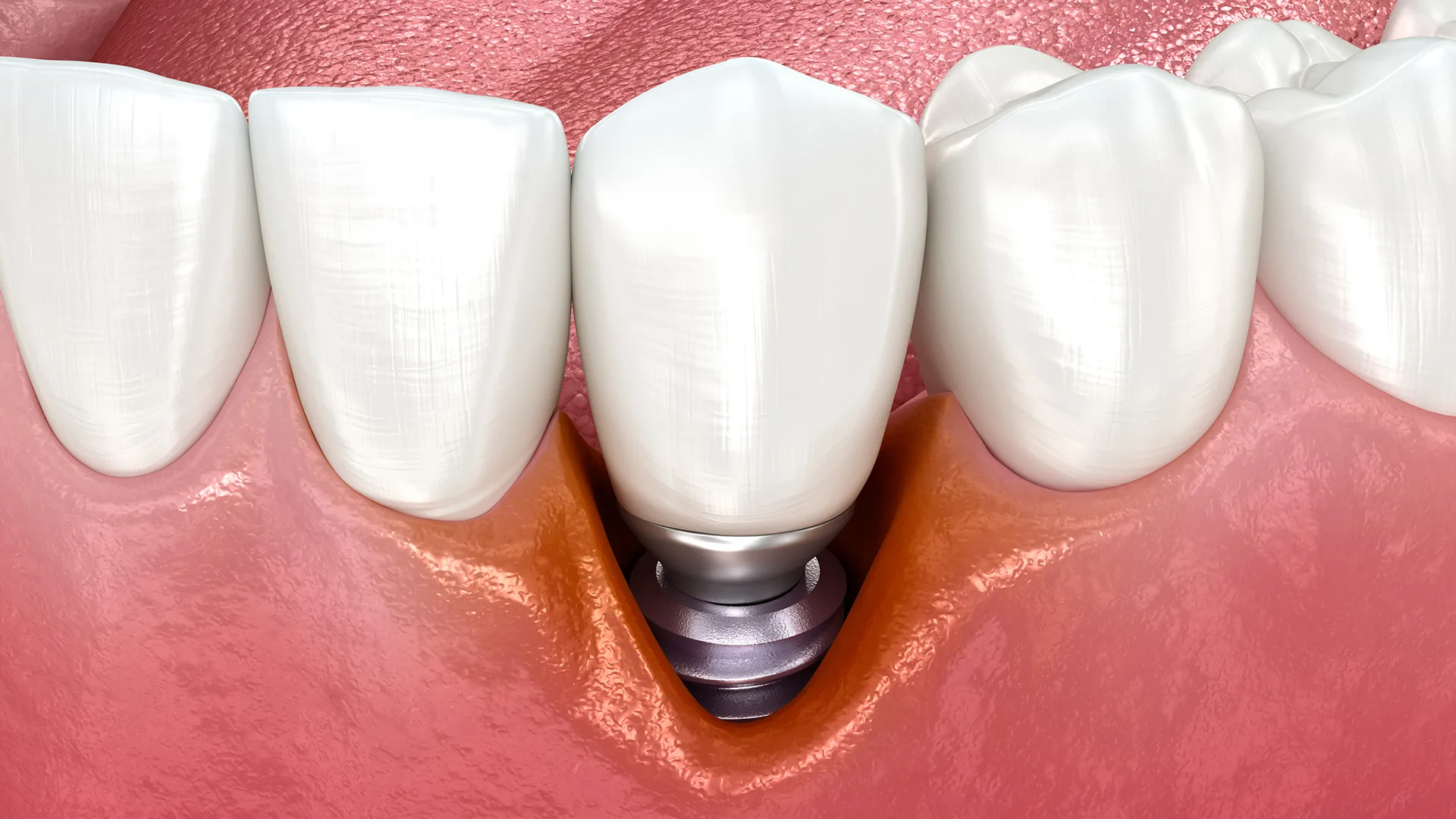 Abbildung eines Gebisses