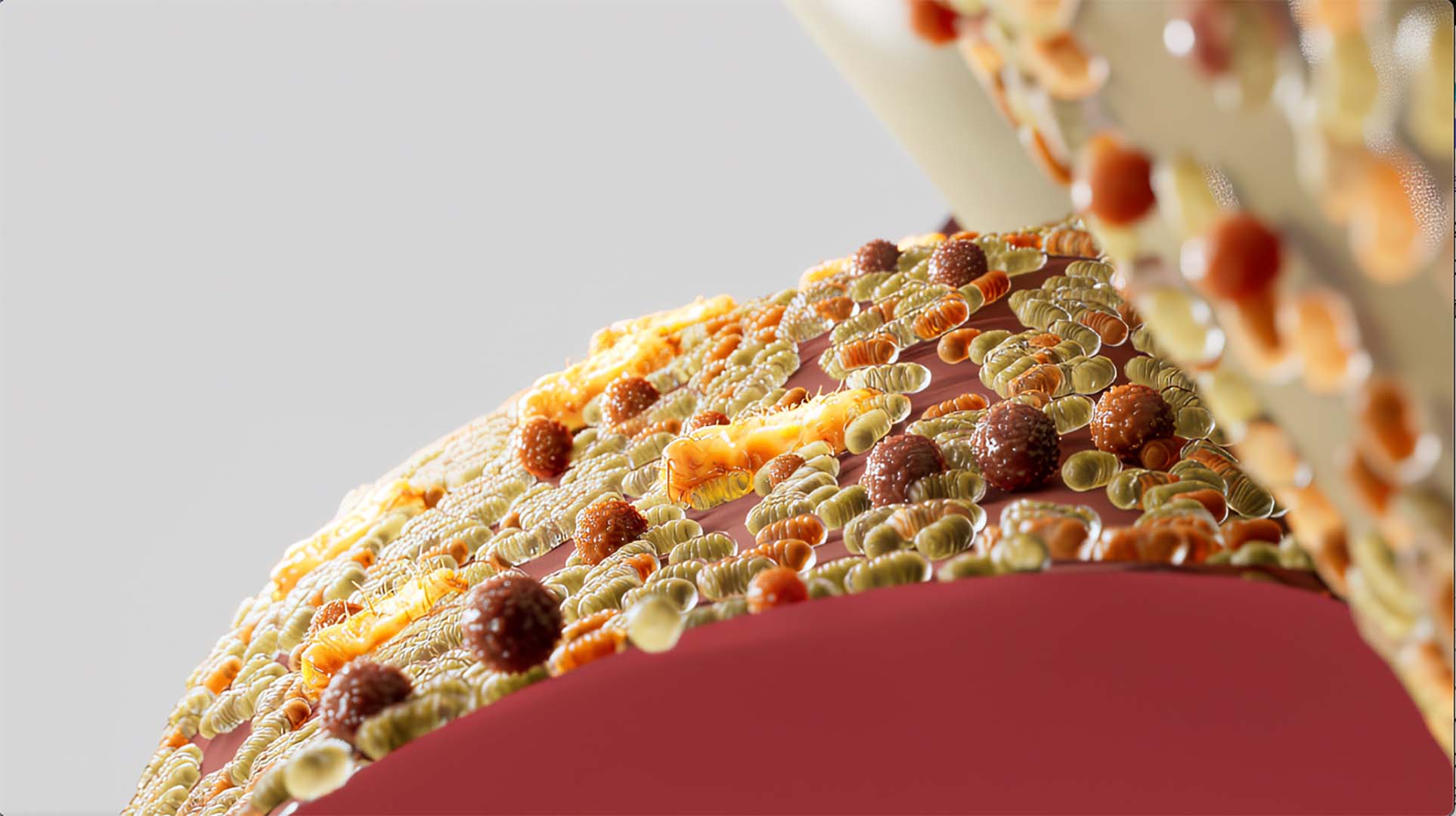 Schematische Darstellung des durch P. gingivalis veränderten Mikrobioms. Das Zahnfleisch ist zurückgegangen und gerötet.