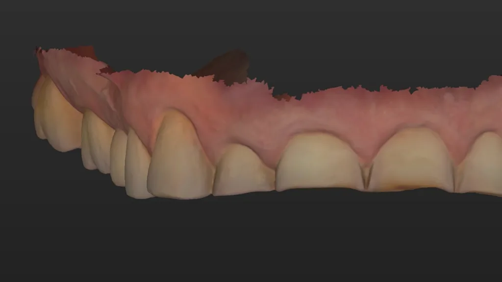 Intraoraler Scan des Oberkiefers, wo starker Zahnabrieb zu erkennen ist