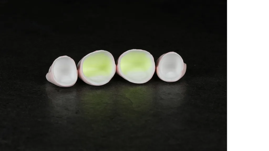 Behandlung der Innenflächen der Kronen