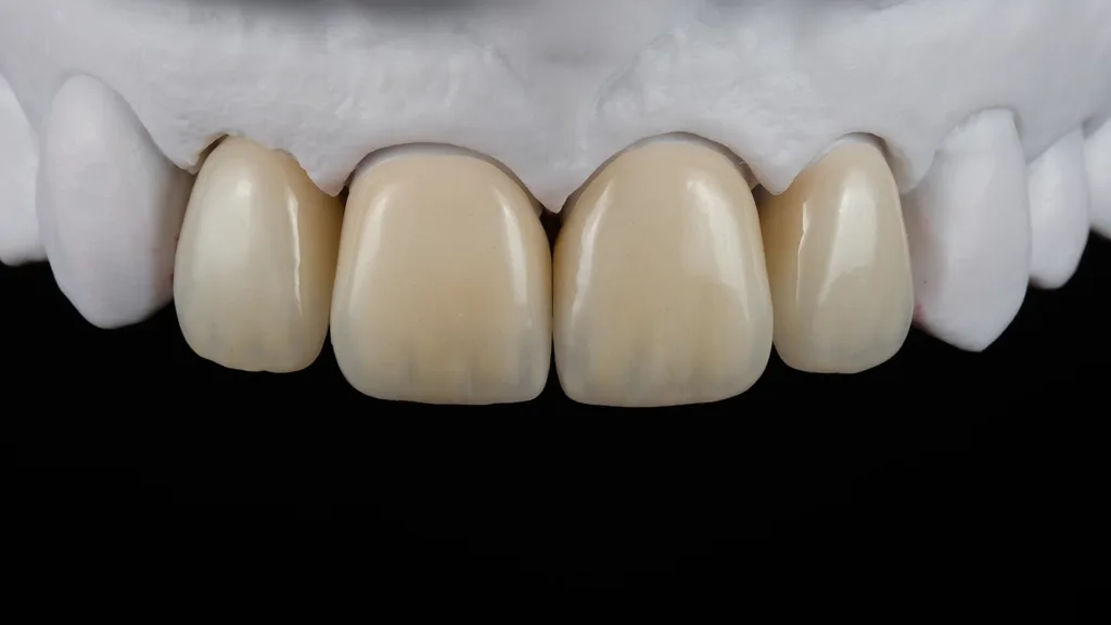 Frontalansicht der Restauration auf dem Modell