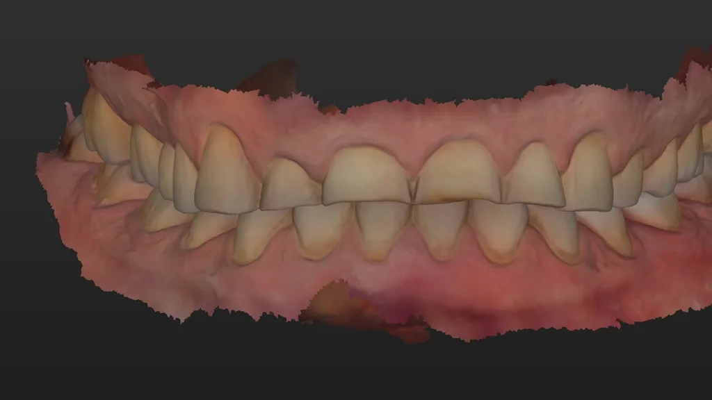 Intraoraler Scan beider Kiefer, der die Notwendigkeit einer Erhöhung der VDO bestätigt