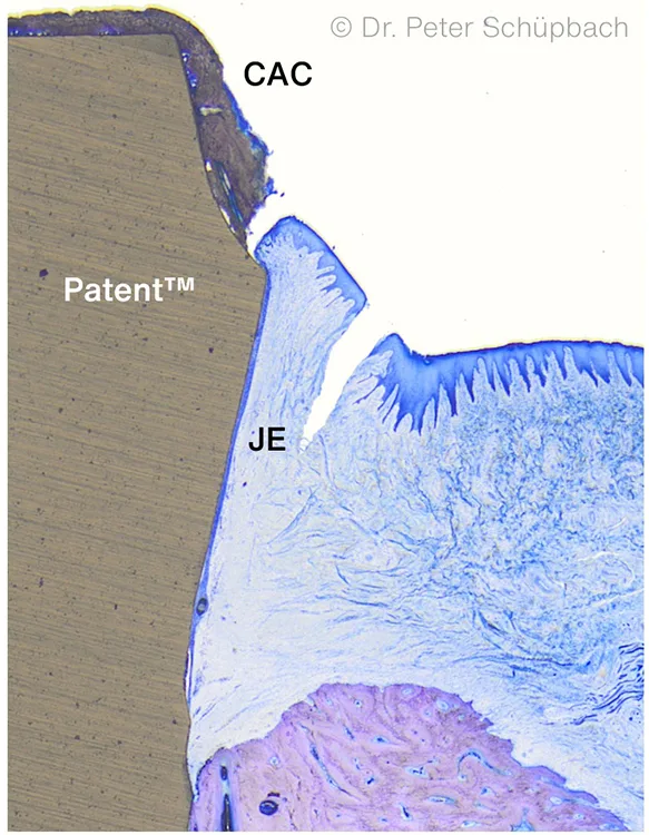 Abb. 2: Histologischer Querschnitt zeigt den Verbund zwischen Saumepithel (JE) und Patent™ Oberfläche, welcher die Migration von Plaque und Zahnstein (CAC) in die Gewebe verhindert